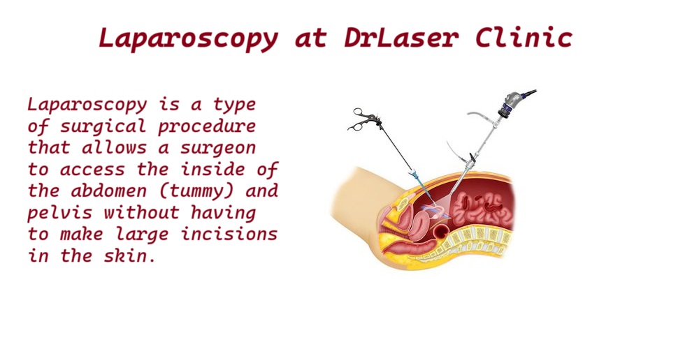 Laparoscopy in Colorectal Surgery
