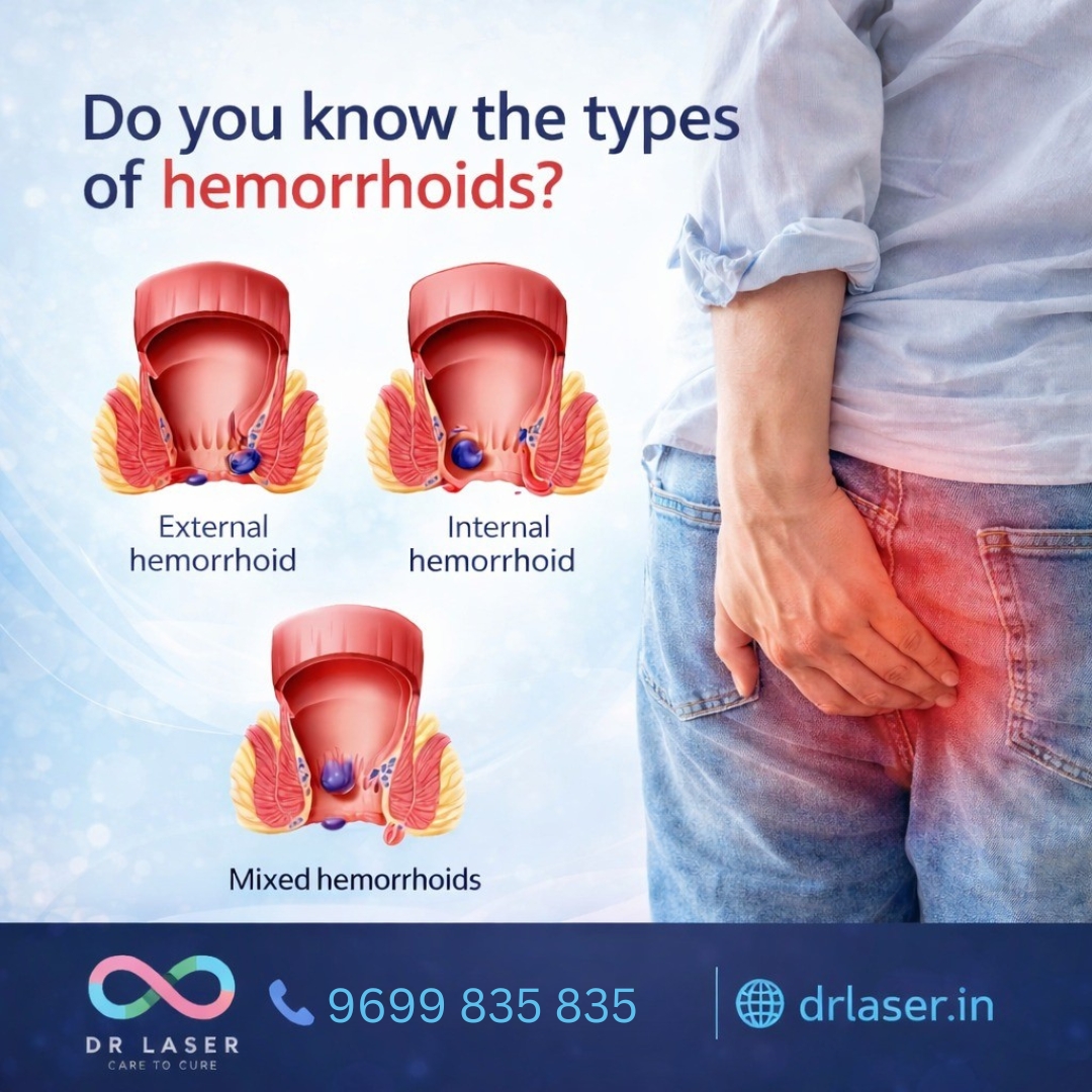Hemorrhoids can be external, internal, or mixed and each type needs the right approach. 