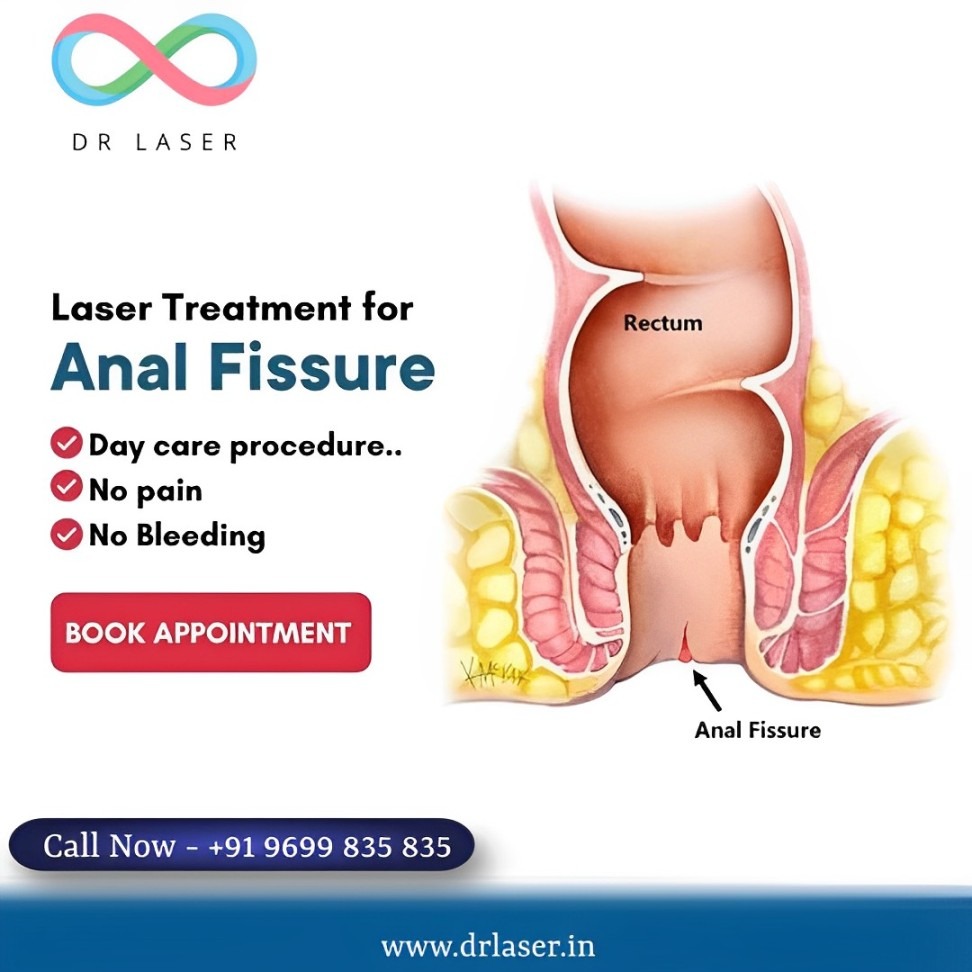 Advanced Laser Treatment for Anal Fissure