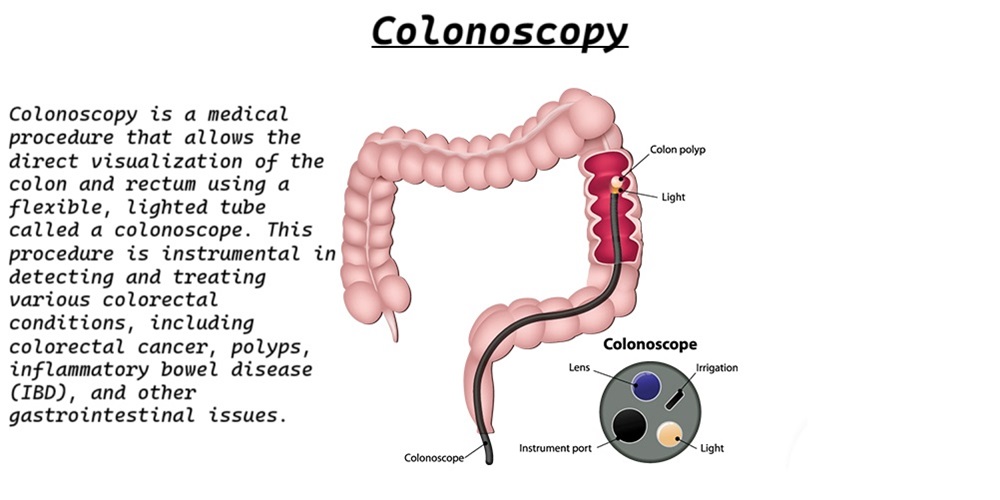 Colonoscopy