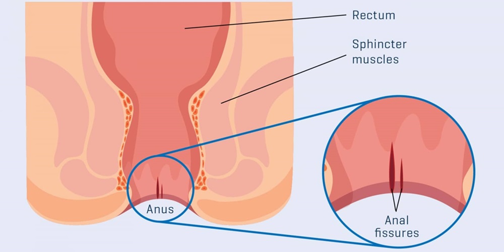 Botox for Anal Fissure