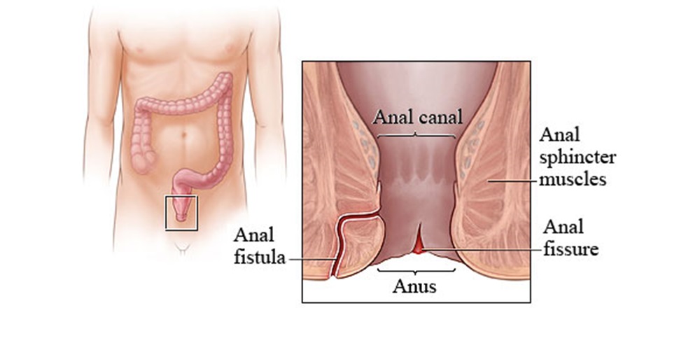 Anal Fitsula