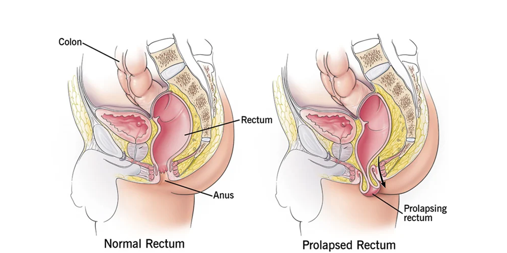 Rectal Prolapse